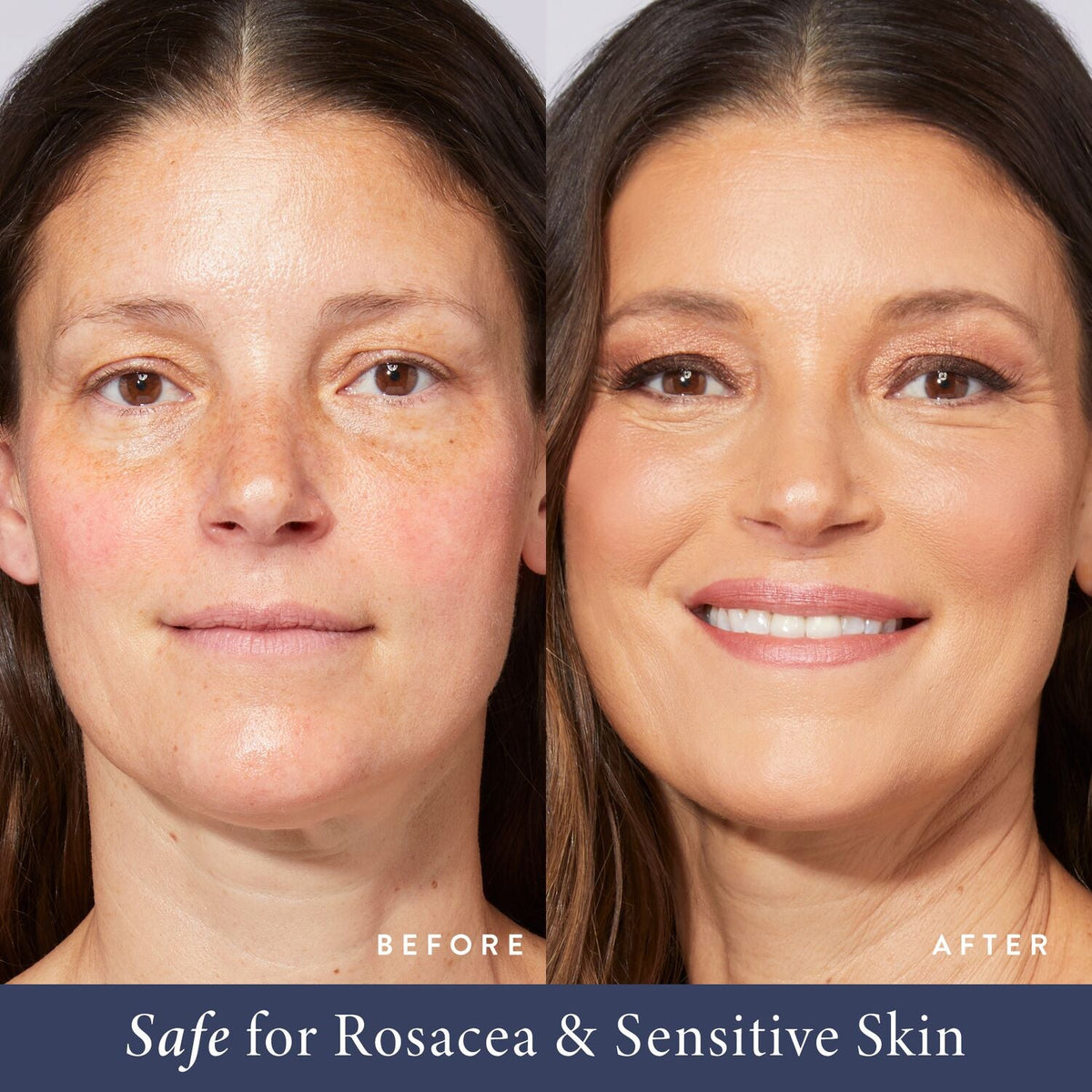Balance-n-Brighten - Rosacea Model B&A